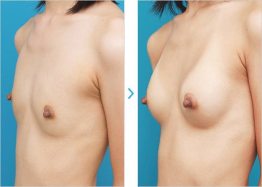 【※偽乳】「豊胸手術」のビフォーアフター。これは騙されるわｗｗｗｗｗｗ・16枚目