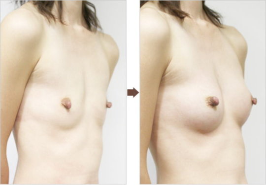 【※偽乳】「豊胸手術」のビフォーアフター。これは騙されるわｗｗｗｗｗｗ・17枚目