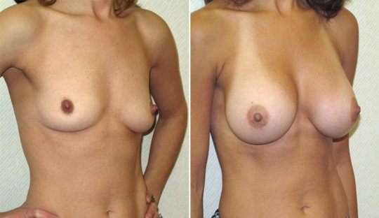 【※偽乳】「豊胸手術」のビフォーアフター。これは騙されるわｗｗｗｗｗｗ・18枚目